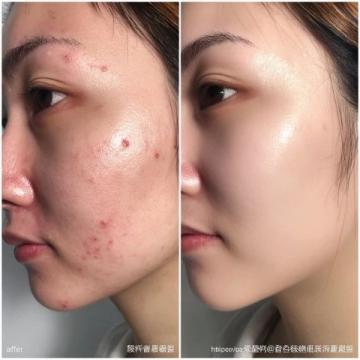因为史湘云的脸上犯了杏斑癣,于是有了治疗药物蔷薇硝出场,但是被茉莉粉